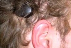 Cirurgia do ‘ouvido biônico’ é tema de curso na OSID